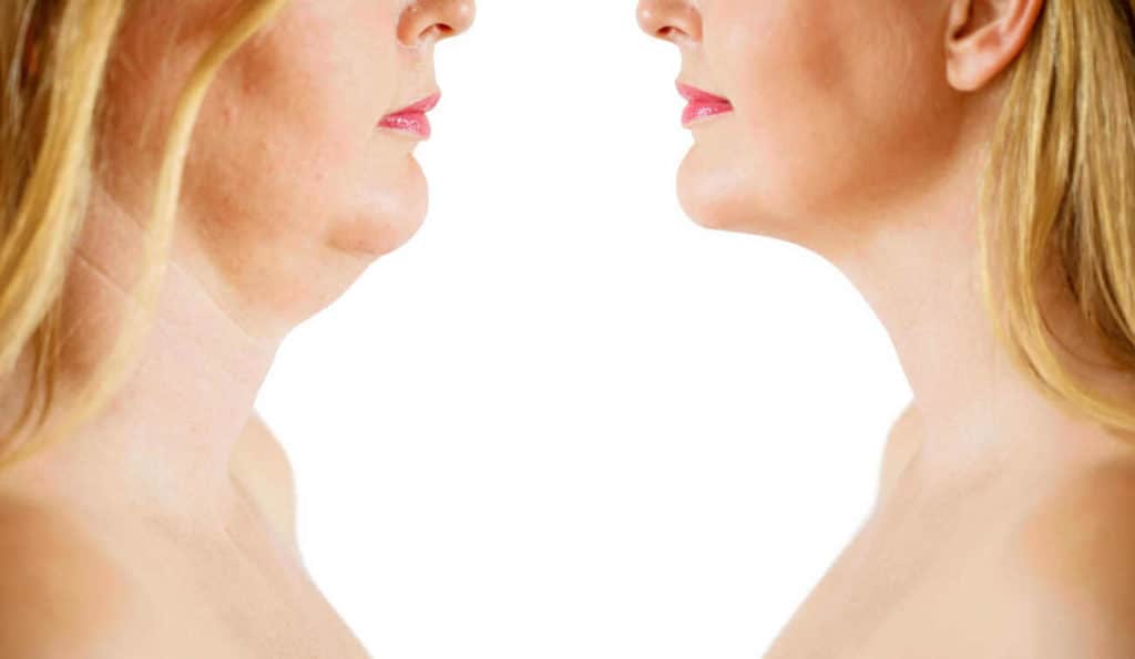 Double Chin treatment Stoke-upon-Trent before and after results