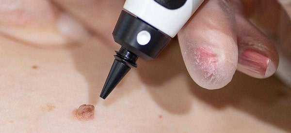 After Skin Tag Removal Stoke-upon-Trent