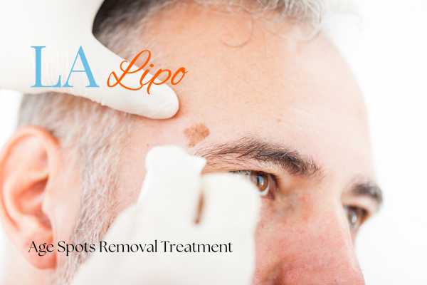 What Are the Most Effective Treatments for Age Spots Stoke-upon-Trent?