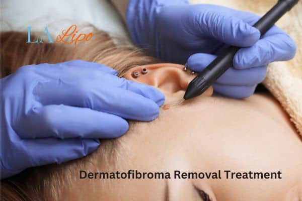 Dermatofibroma Removal Treatment Stoke-upon-Trent