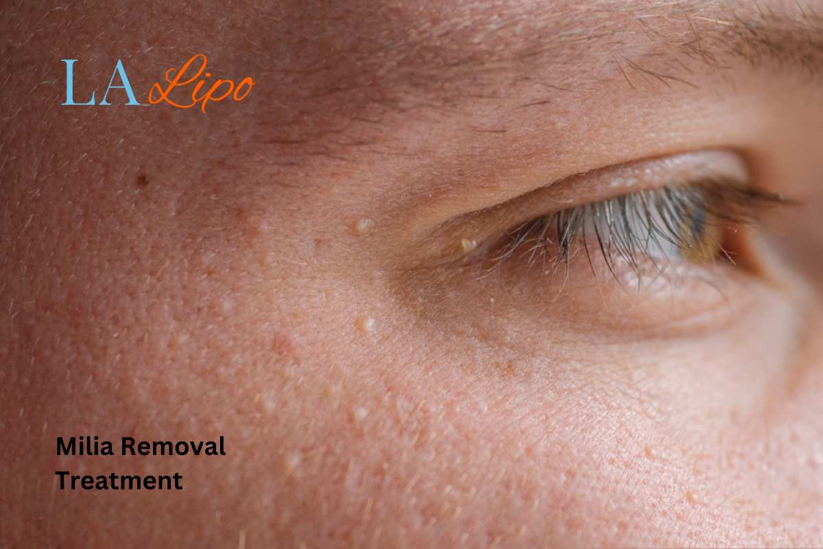 Cryopen Milia Removal: Is It the Easiest and Safest Option Stoke-upon-Trent?