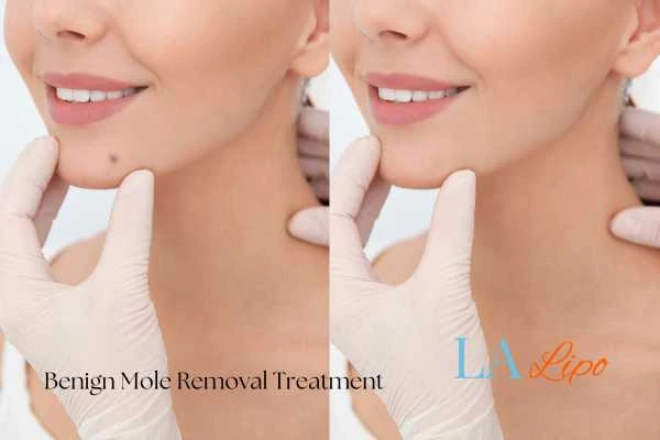 woman's before and after mole removal Stoke-upon-Trent results