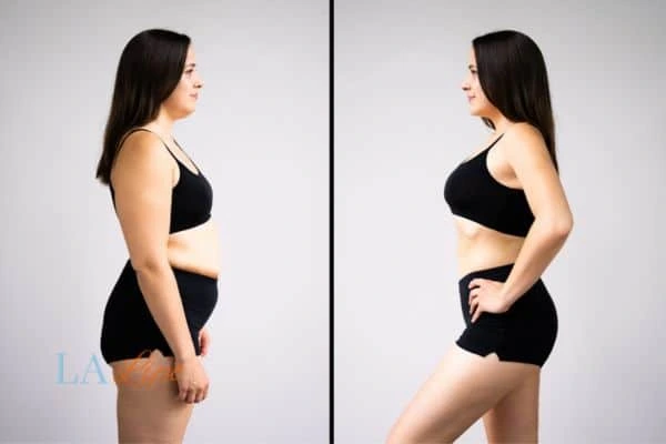 image of woman before and after results of LA-EMS Body Sculpting Stoke-upon-Trent to help treat Diastasis recti