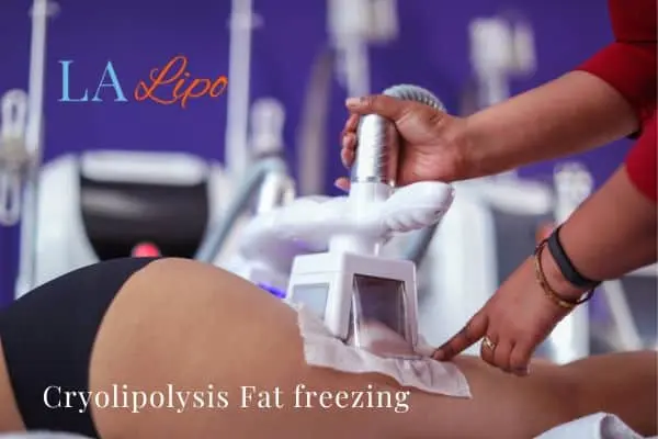 women getting fat freezing Stoke-upon-Trent