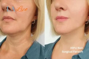 hi-fu for wrinkles Stoke-upon-Trent before and after results