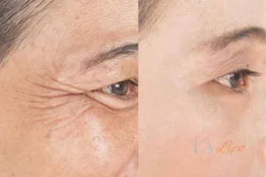 Before and after results of woman - HI-fu wrinkles reduction treatment Stoke-upon-Trent