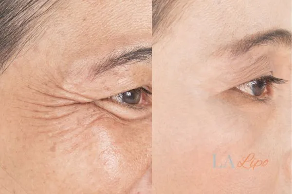 Before and after results of woman - HI-fu wrinkles reduction treatment Stoke-upon-Trent