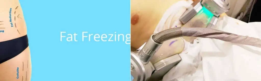 Fat freezing Stoke-upon-Trent on multiple areas of the body