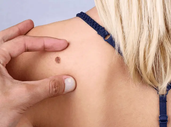 woman having mole removal Stoke-upon-Trent consultation before treatment.