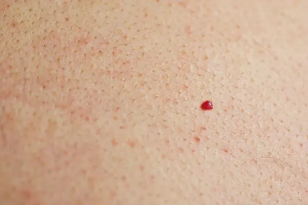 close up of a cherry angioma Stoke-upon-Trent