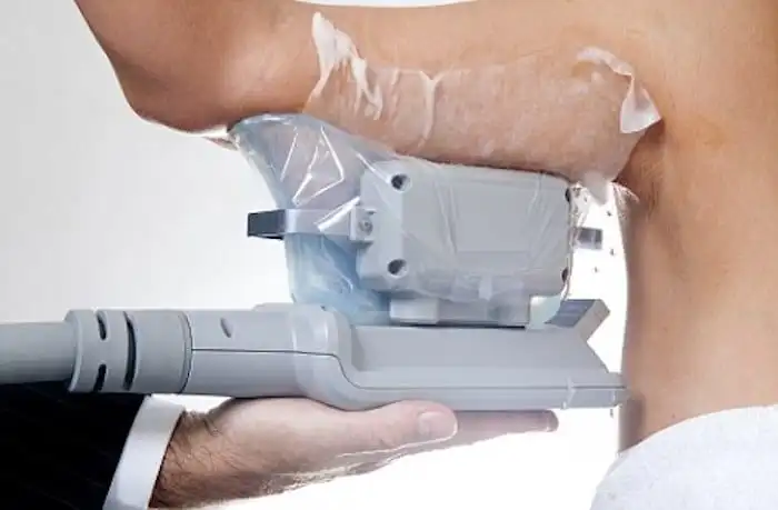 Picture of fat freezing Stoke-upon-Trent on the upper arms.