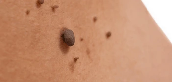 image of a skin tag Stoke-upon-Trent