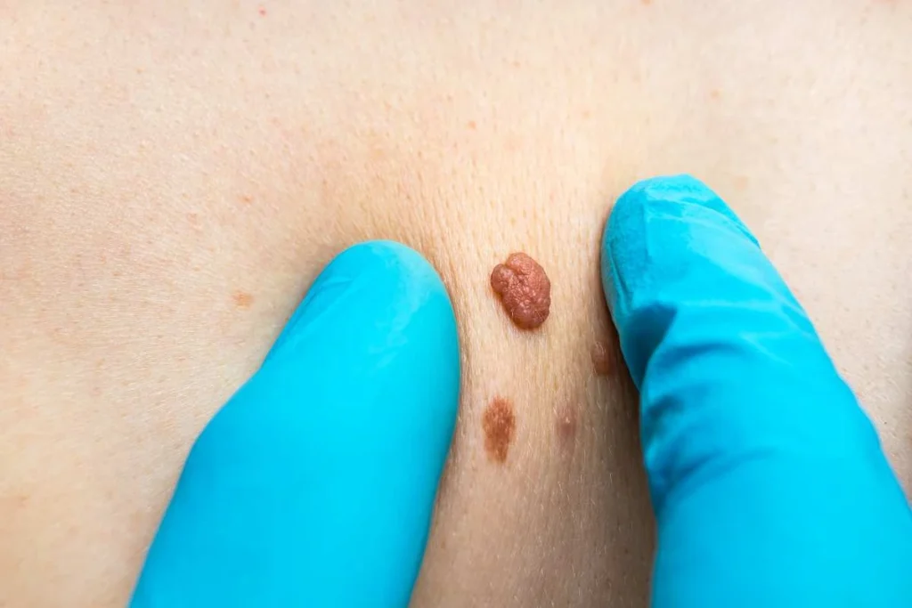 Consultant examining a skin tag Stoke-upon-Trent