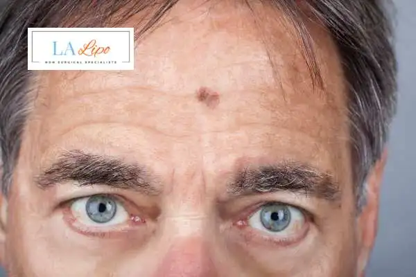 Solar Lentigo Removal Stoke-upon-Trent image of man with mark on his forehead