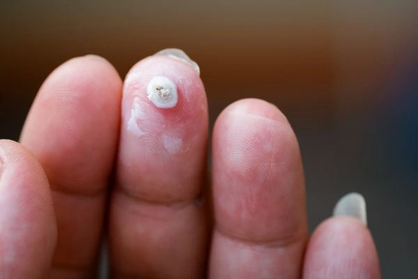 wart on person finger - cryotherapy to treat from LA LIPO Stoke-upon-Trent