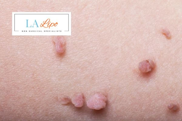 Does cryopen skin tag removal Stoke-upon-Trent hurt? Find out now call our team today!