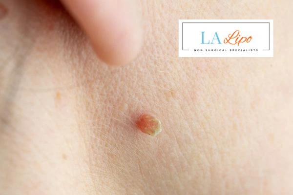Book skin tag removal Stoke-upon-Trent today speak to our team now!