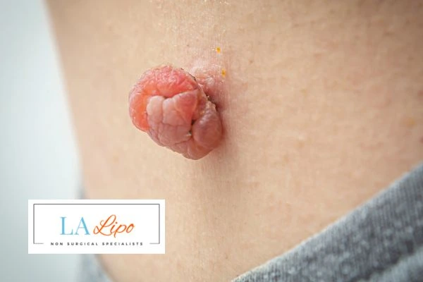 Interested in skin tag removal Stoke-upon-Trent? Concerned about the pain? Find out more today!