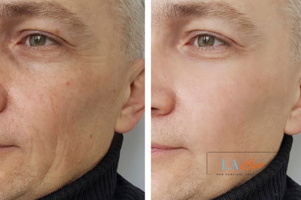 See the amazing results of Morpheus8 Treatment Stoke-upon-Trent!