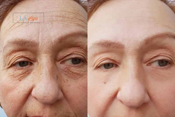 The powerful benefits of Morpheus8 Treatment Stoke-upon-Trent - Call Our team today!