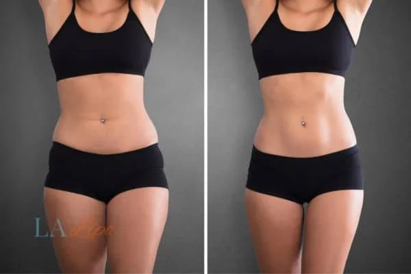 before and after results of non-surgical treatment to help a woman's body image and mental health Stoke-upon-Trent