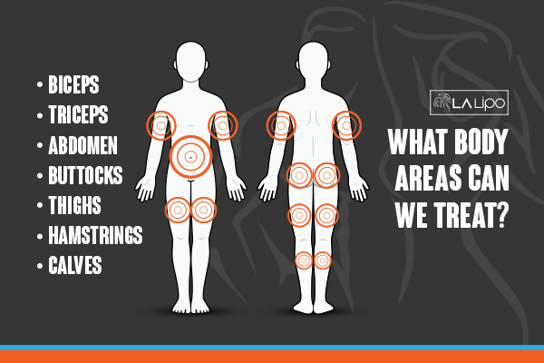 Diagram to show areas you can have LA-EMS Body Sculpting Treatment Stoke-upon-Trent