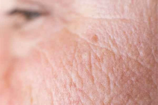 close up picture of a woman's face showing an age spot Stoke-upon-Trent