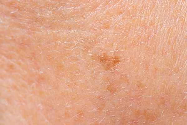 close up picture of age spots Stoke-upon-Trent