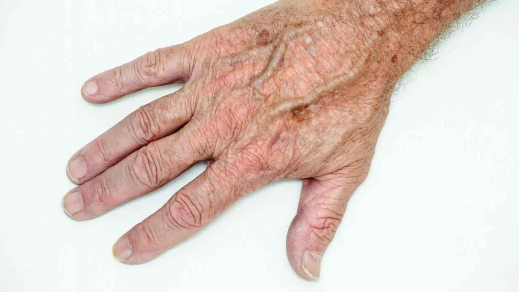 Male hand showing age spot Stoke-upon-Trent