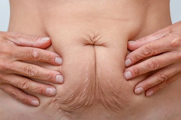 Image of a woman's stomach with loose skin - example of skin tightening Stoke-upon-Trent options