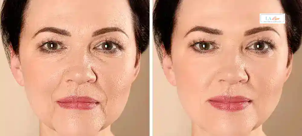 How Long Does It Take to See Results and How Long Do They Last Stoke-upon-Trent?