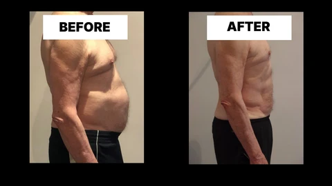 What Symptoms Can Diastasis Recti Cause in Men? Weak Core, Back Pain and Poor Posture Stoke-upon-Trent